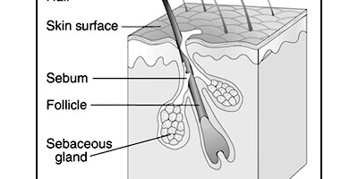 THE 10 MOST COMMON CAUSES OF ACNE